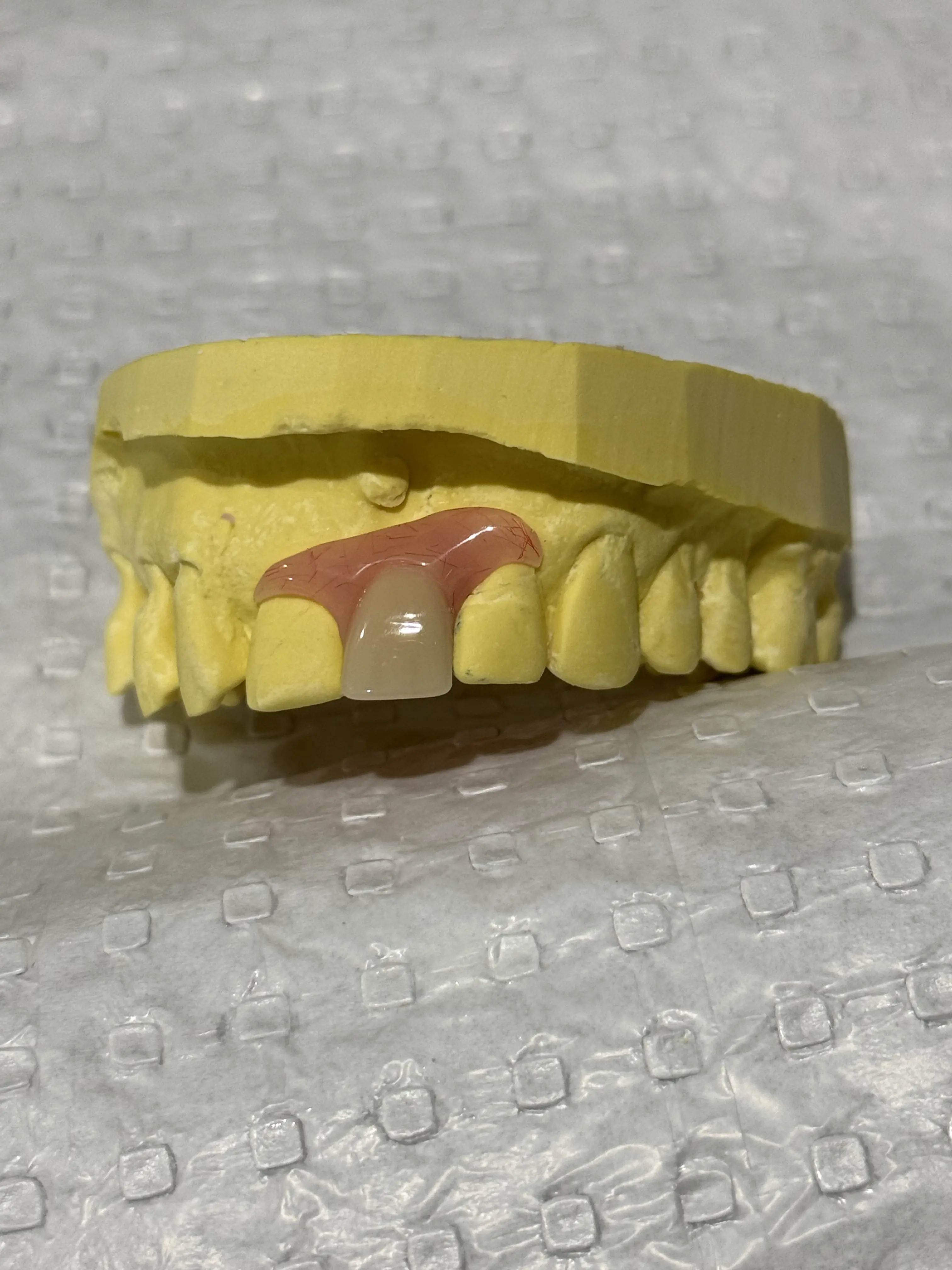 Partial Denture